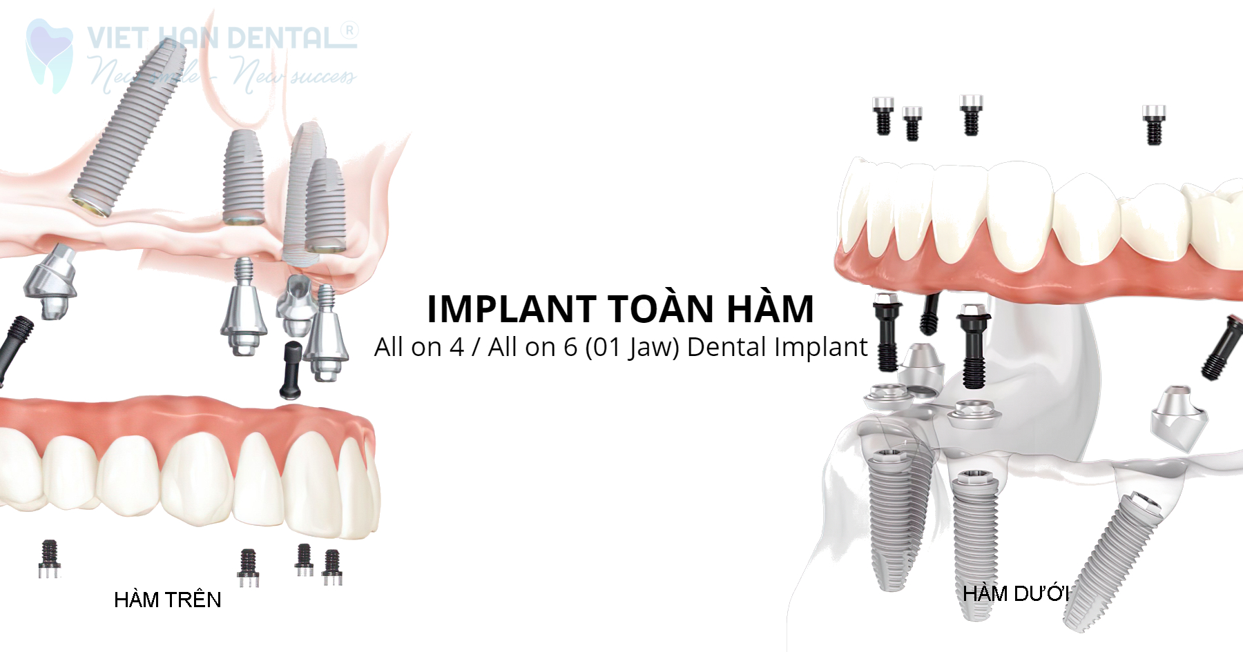 Trồng răng Implant toàn hàm