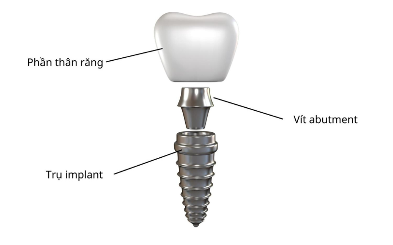 Cấu trúc của trụ răng Implant