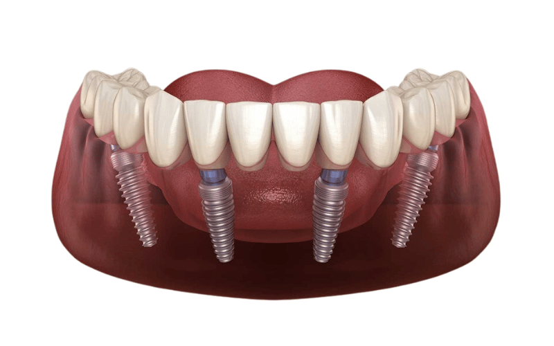 Ưu điểm của cấy ghép Implant All-On-4