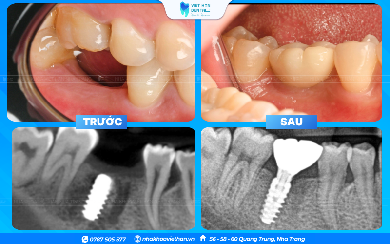 Implant truyền lực nhai xuống xương hàm, giúp duy trì mật độ xương