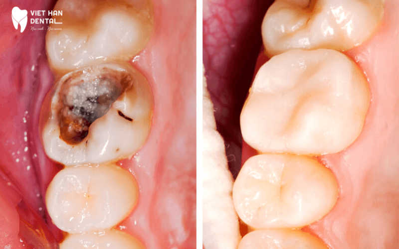 Sâu răng được hình thành thói quen ăn uống không lành mạnh và không chăm sóc cẩn thận