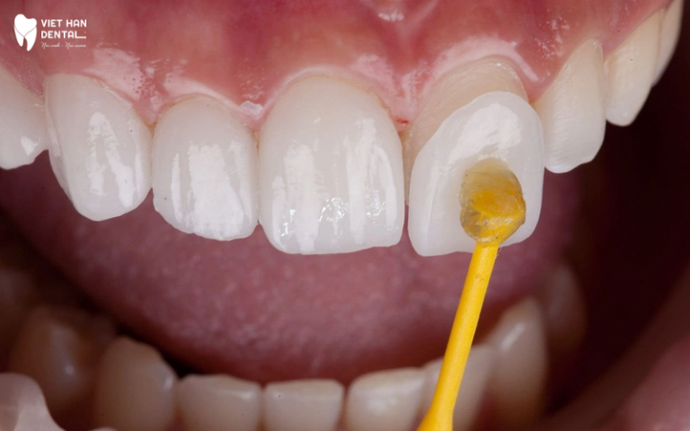 án sứ Veneer