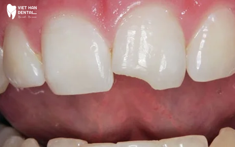 Trám để khôi phục lại cấu trúc răng ban đầu