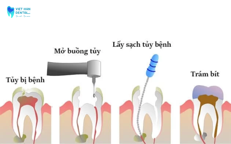 Quy trình điều trị tủy răng