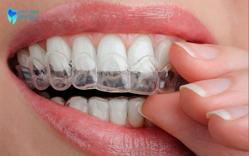 Tẩy trắng răng có hại không?