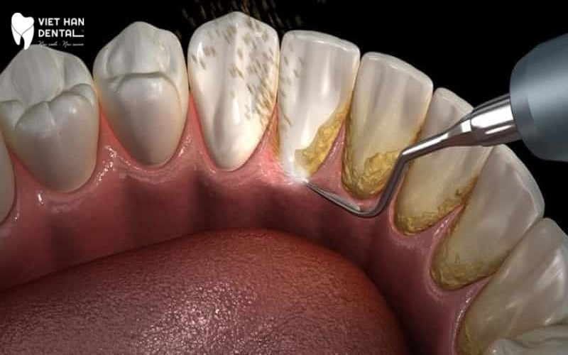 4Vì sao phải cạo vôi răng?
