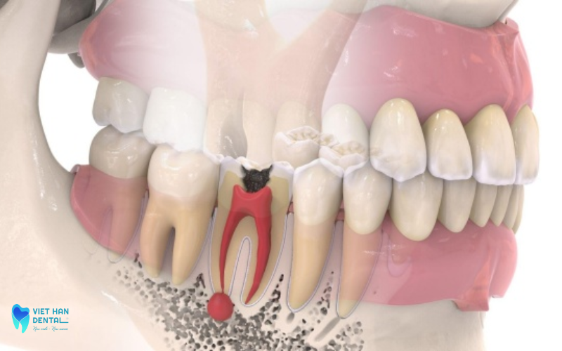 4Vì sao bạn cần phải điều trị tuỷ?