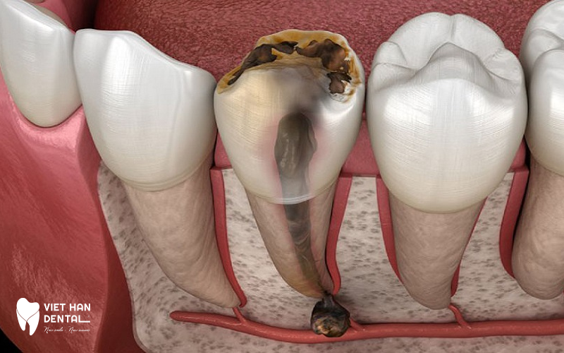 Việt Hàn – Địa chỉ điều trị tuỷ hàng đầu Nha Trang