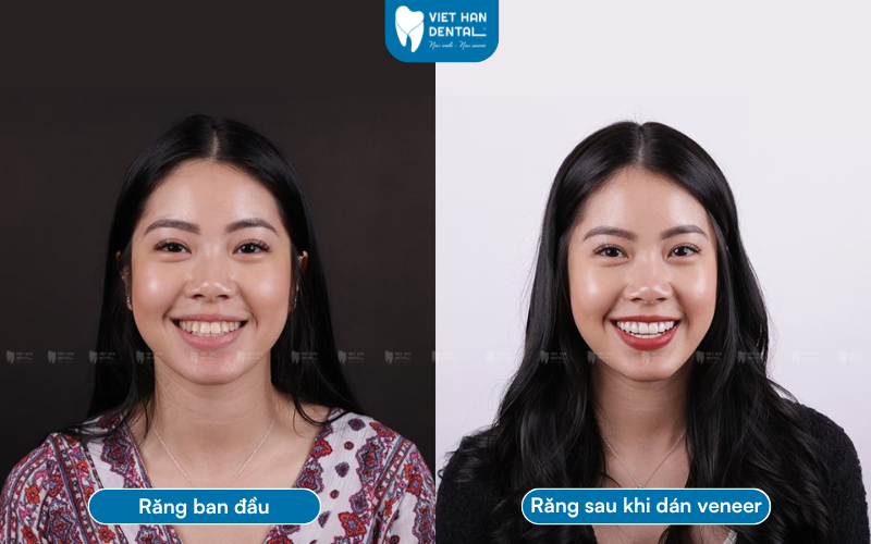 Khách hàng dán sứ Veneer tại Nha khoa Việt Hàn