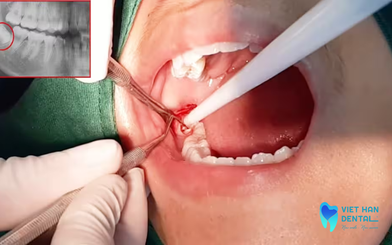 Răng khôn nằm ở vị trí cuối cùng trong hà