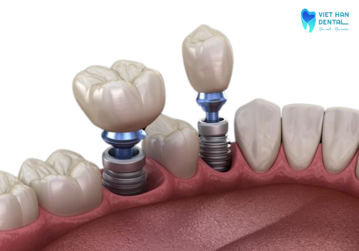 Trồng răng implant đơn lẻ