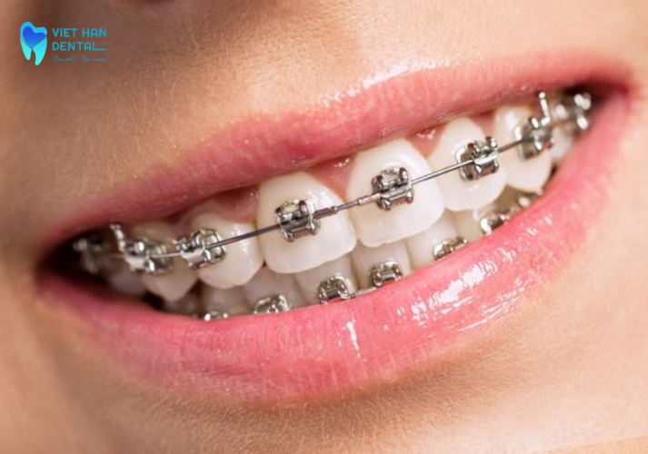 Niềng răng mắc cài