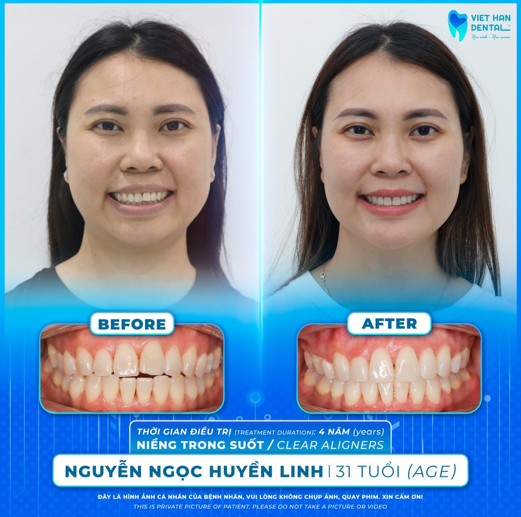Khách hàng Huyền Linh - Niềng răng tỏng suốt tại Nha khao Việt Hàn