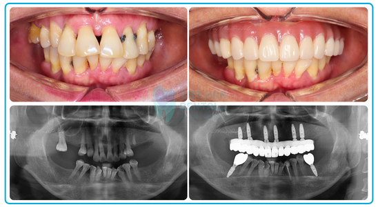 Hình ảnh răng của khách hàng trước và sau khi trồng răng Implant All-on-6 