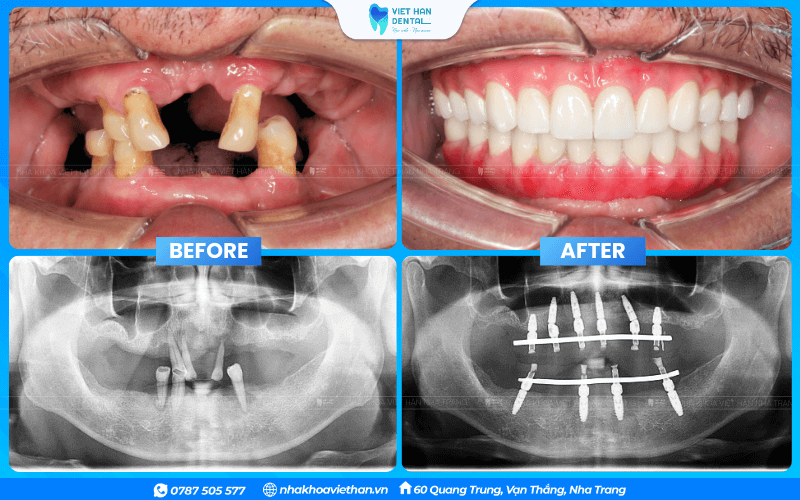 Chú Võ Đức Sử trước và sau khi trồng răng Implant toàn hàm
